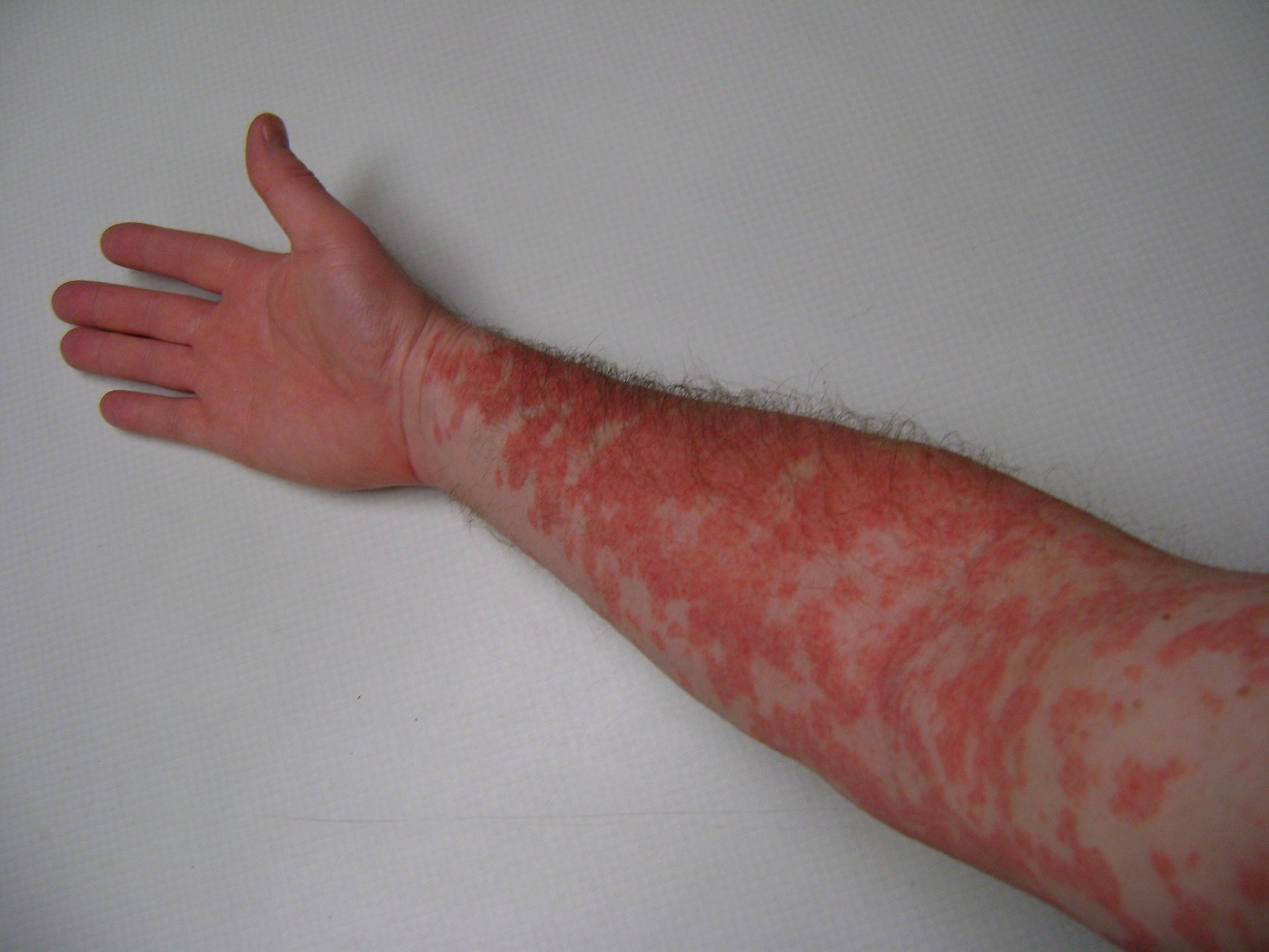 Mononucleosis Amoxicillin Rash Amjmed Com Article S0002